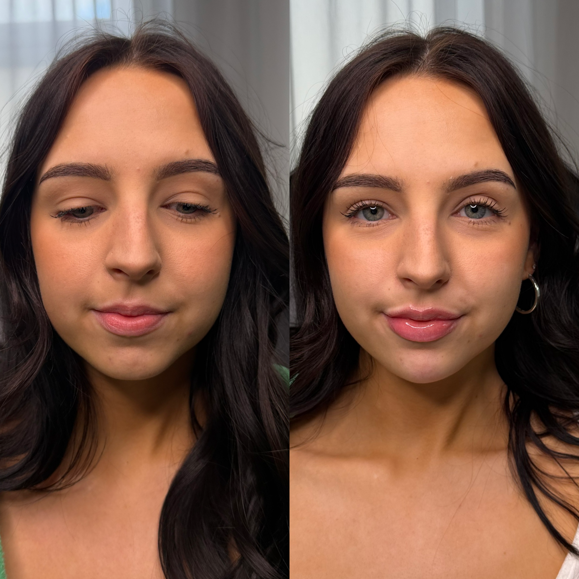 Lip Filler