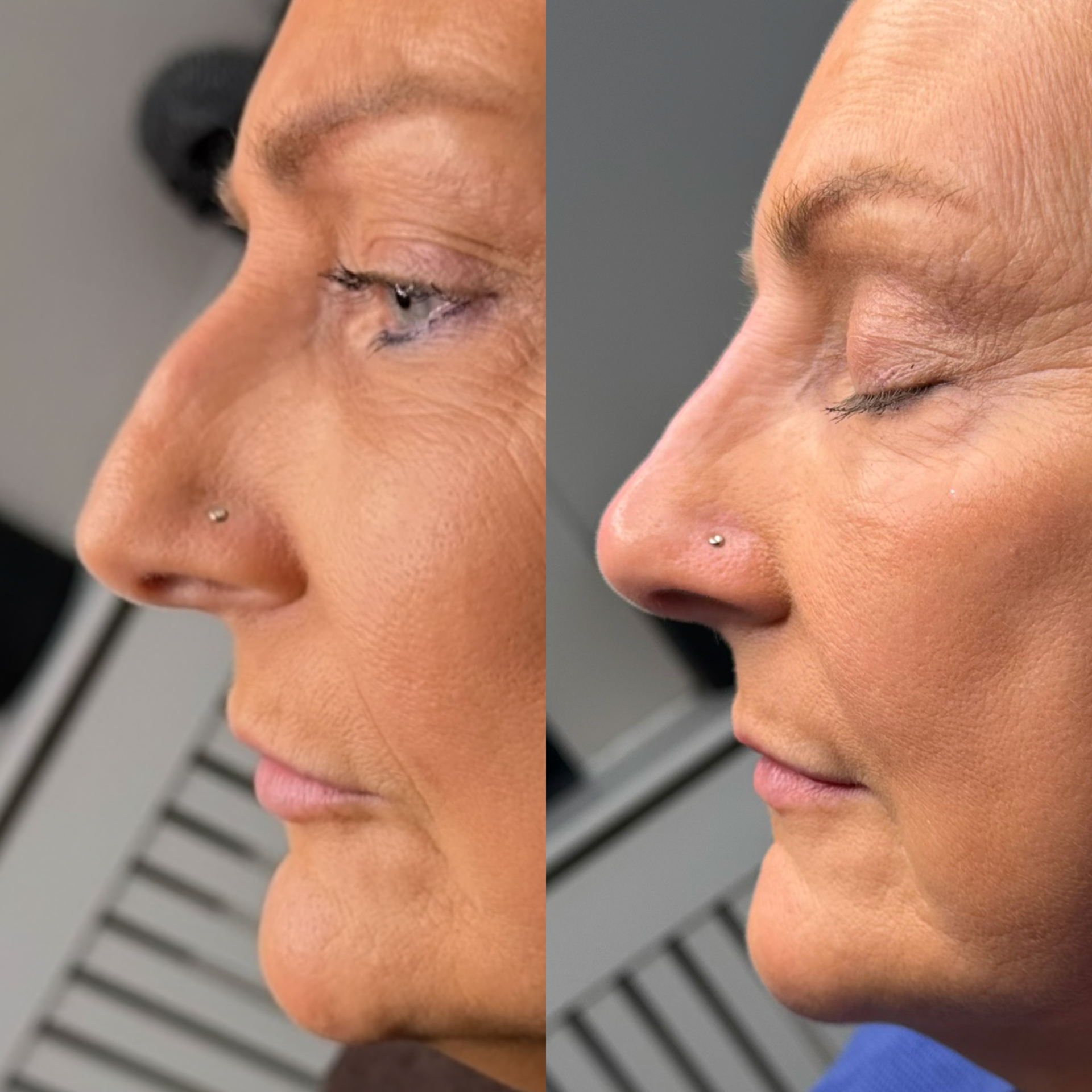 Nose Filler