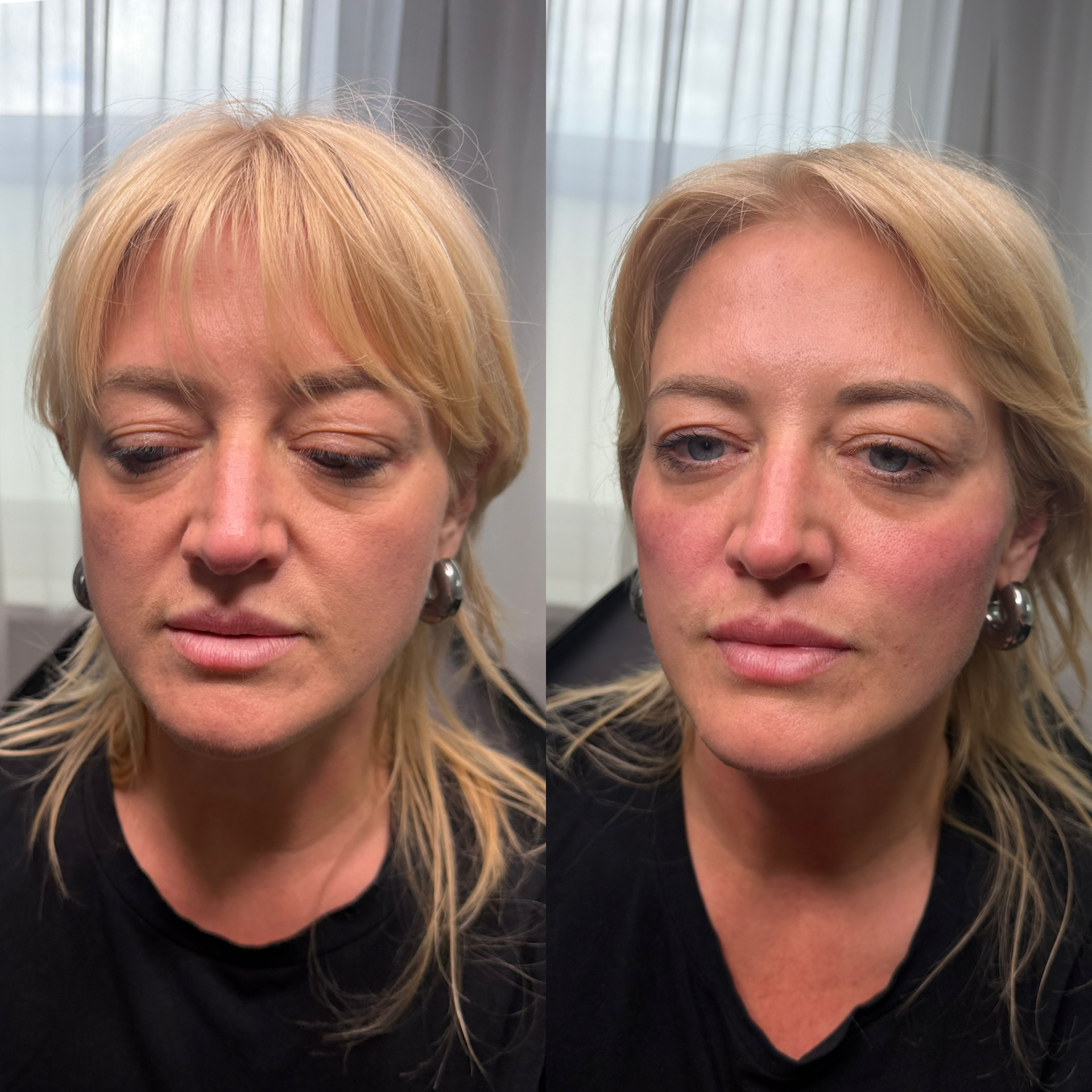 Facial Filler