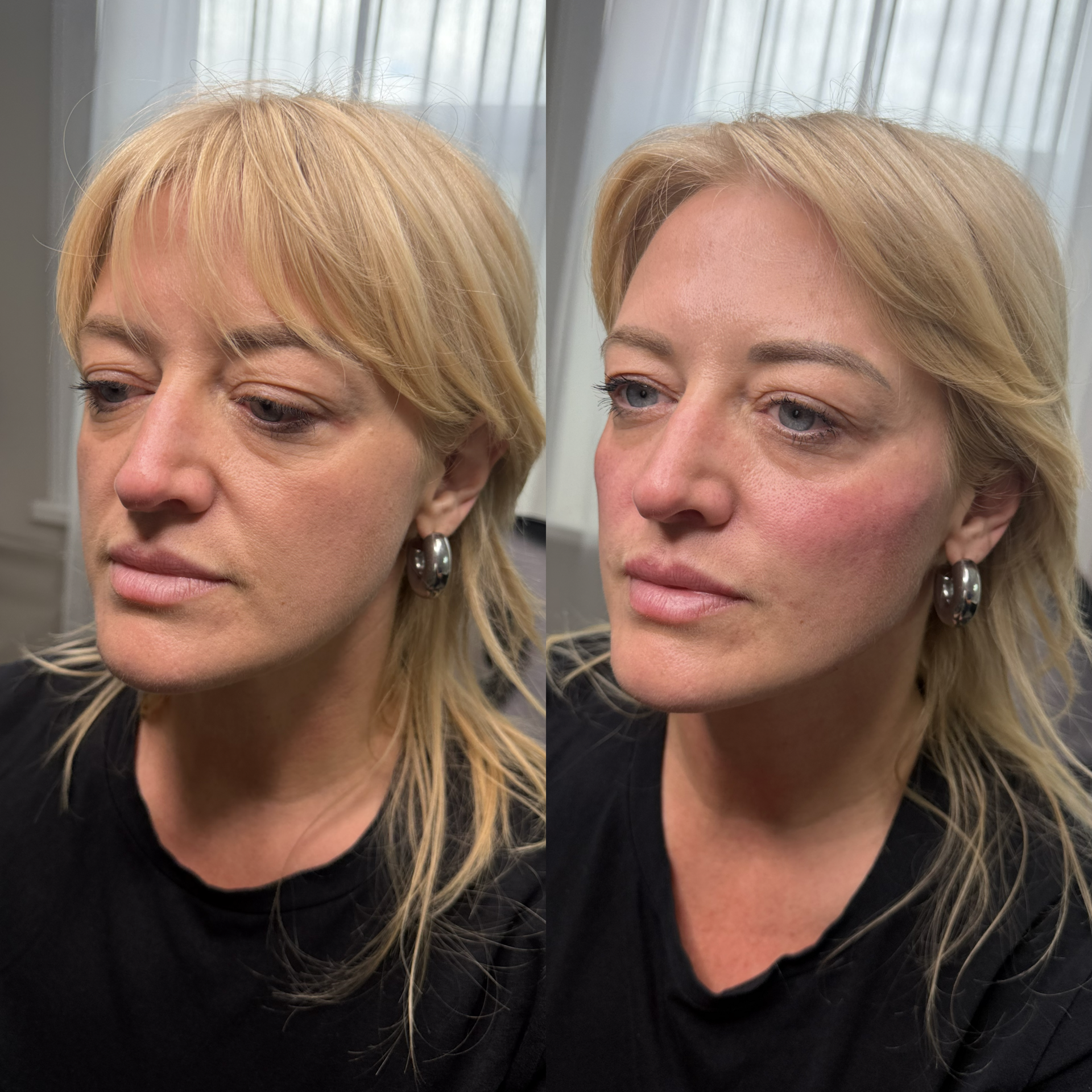 Facial Filler