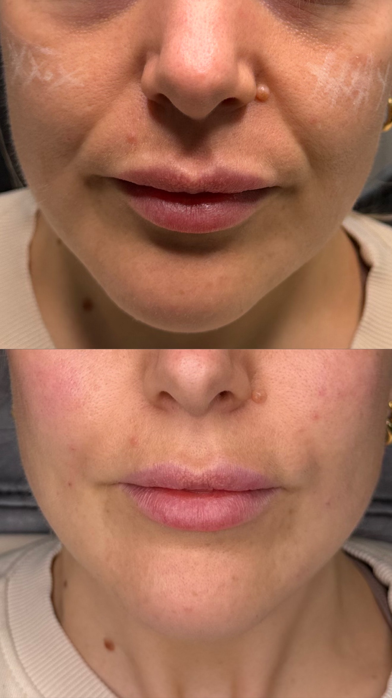 Lip Filler